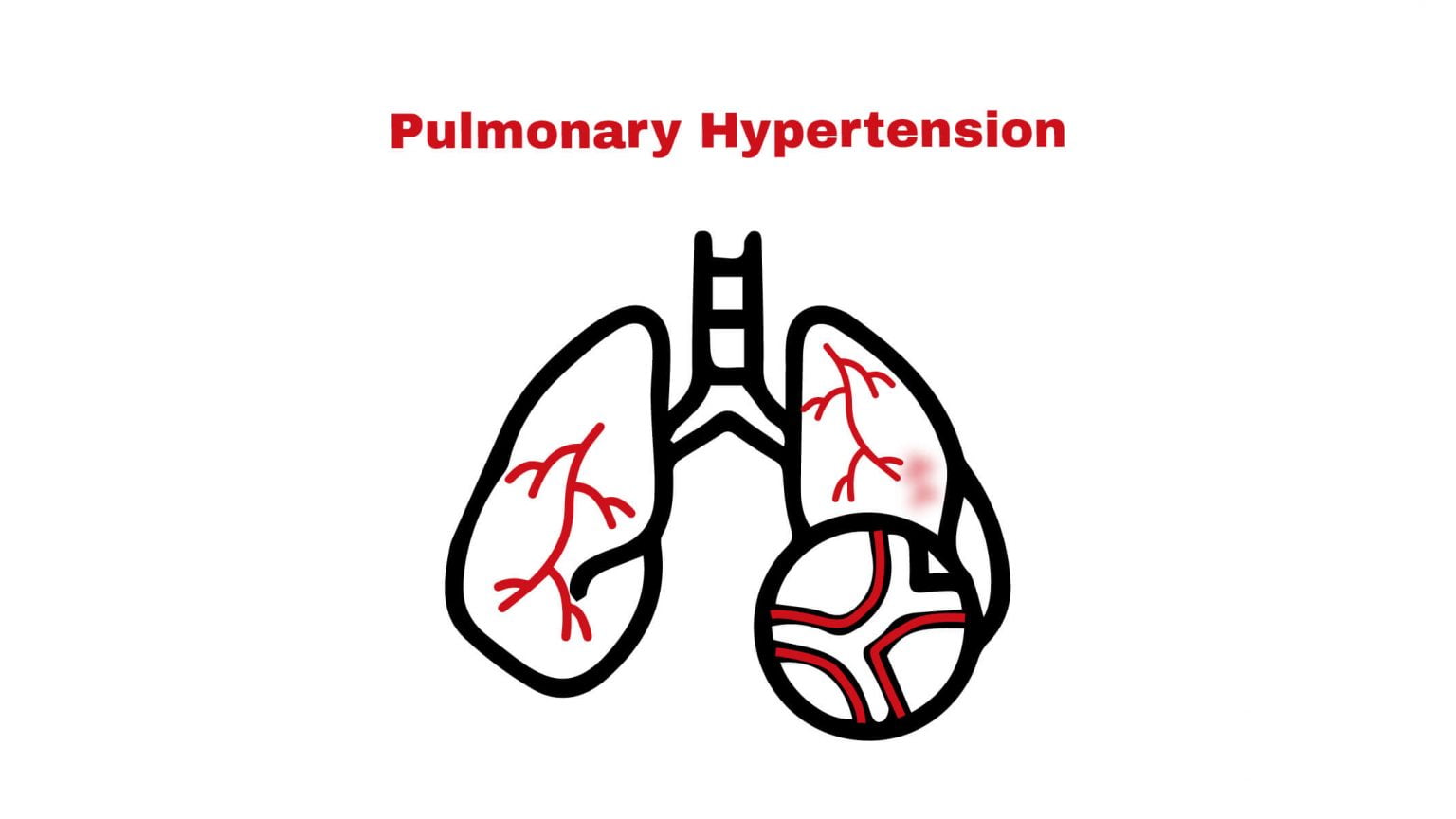 Pulmonary Hypertension (PH) Stat Cardiologist