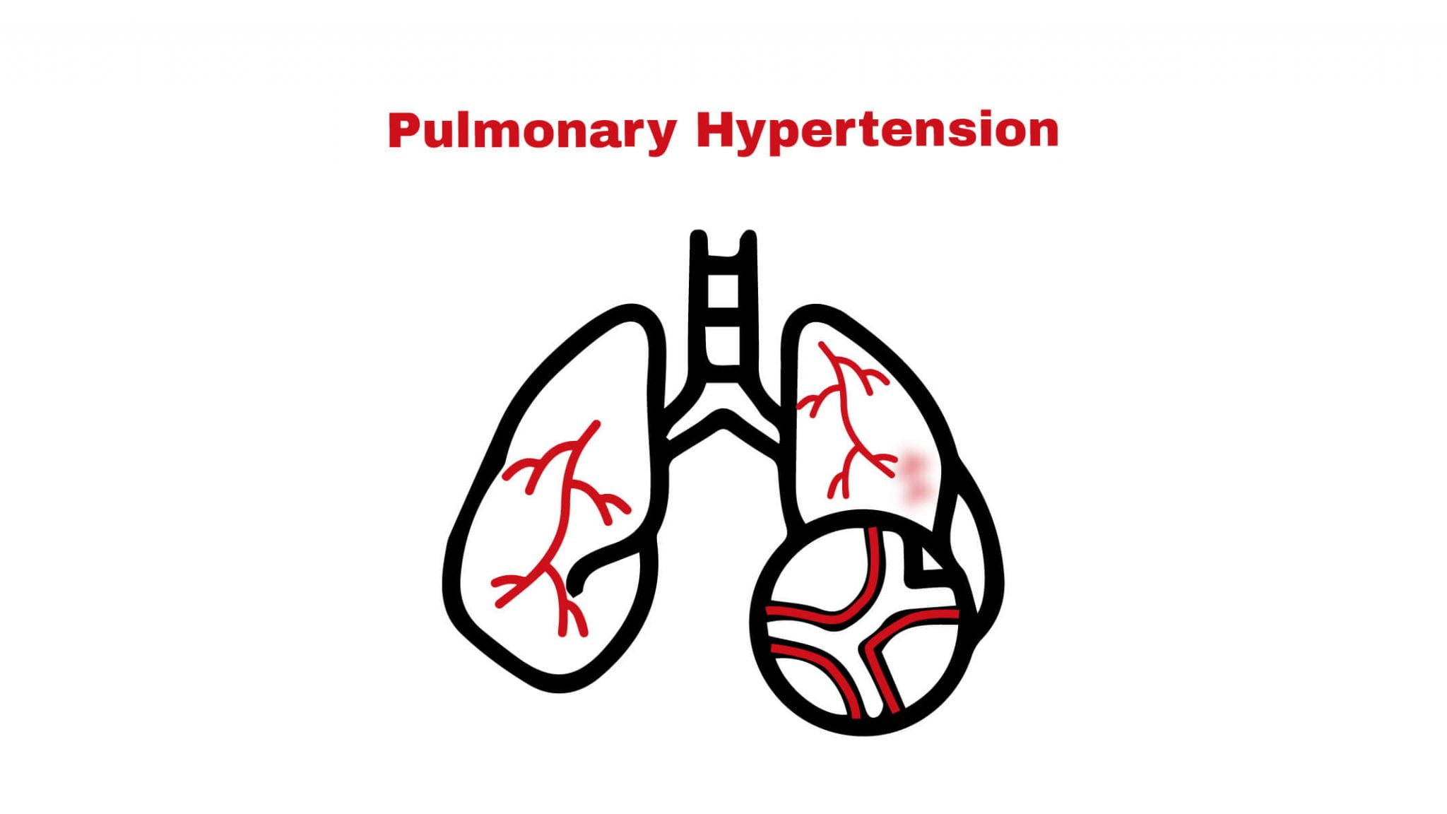 Pulmonary Hypertension (PH) ~ Stat Cardiologist