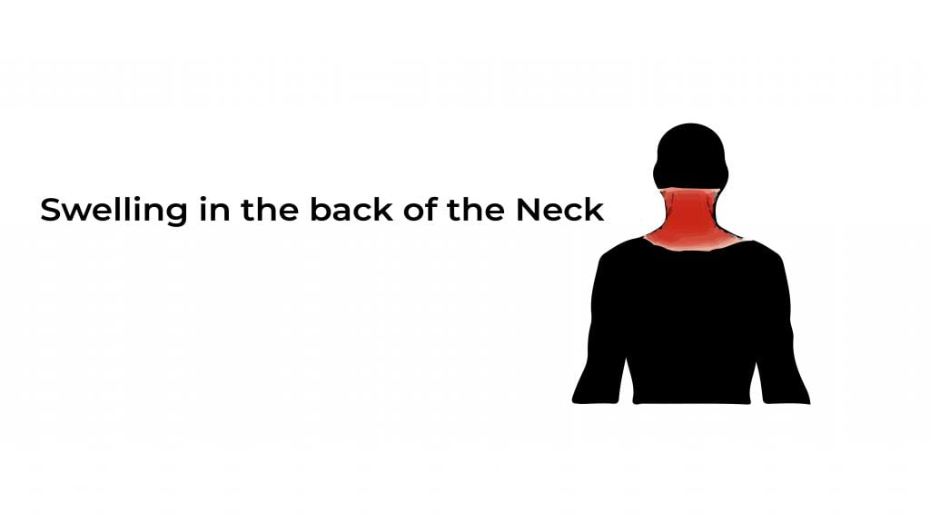 swelling-in-the-back-of-the-neck-statcardiologist