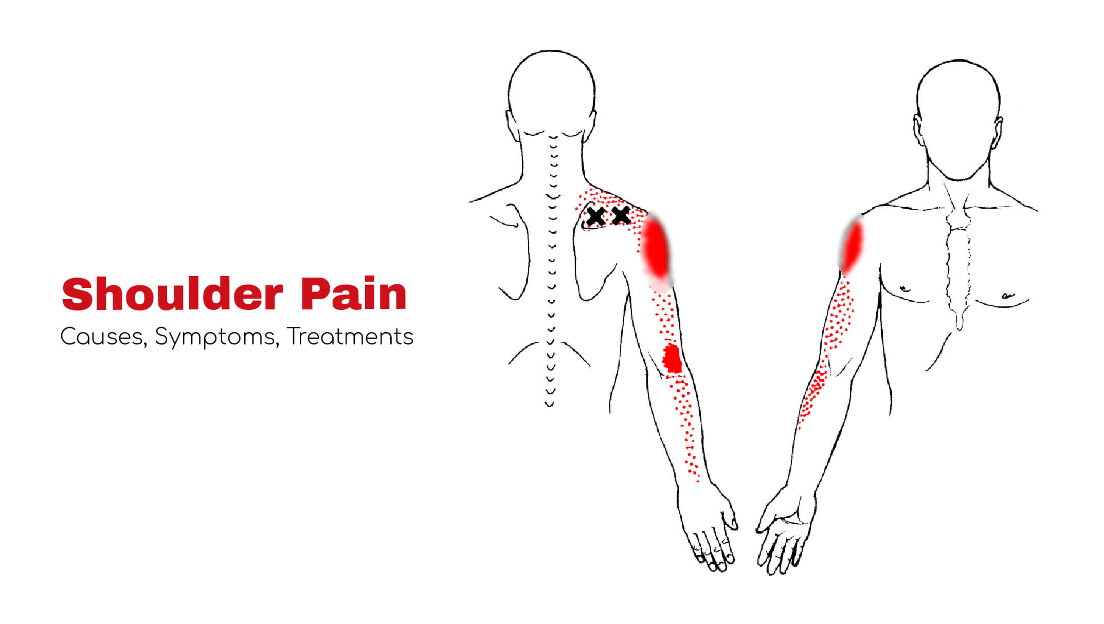 Shoulder Pain Causes Symptoms Treatments Statcardiologist