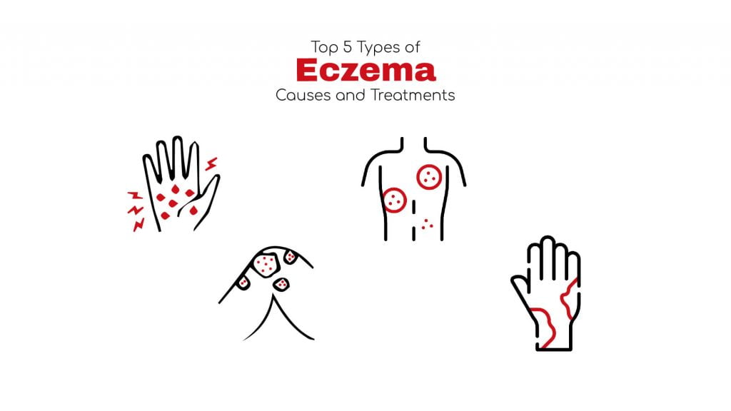 Top 5 Types of Eczema Treatment and Causes ~ Stat! Cardiologist