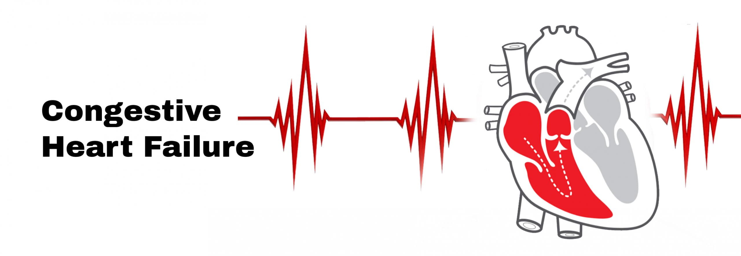 congestive-heart-failure-and-heart-transplant-low-ef-stat-cardiologist