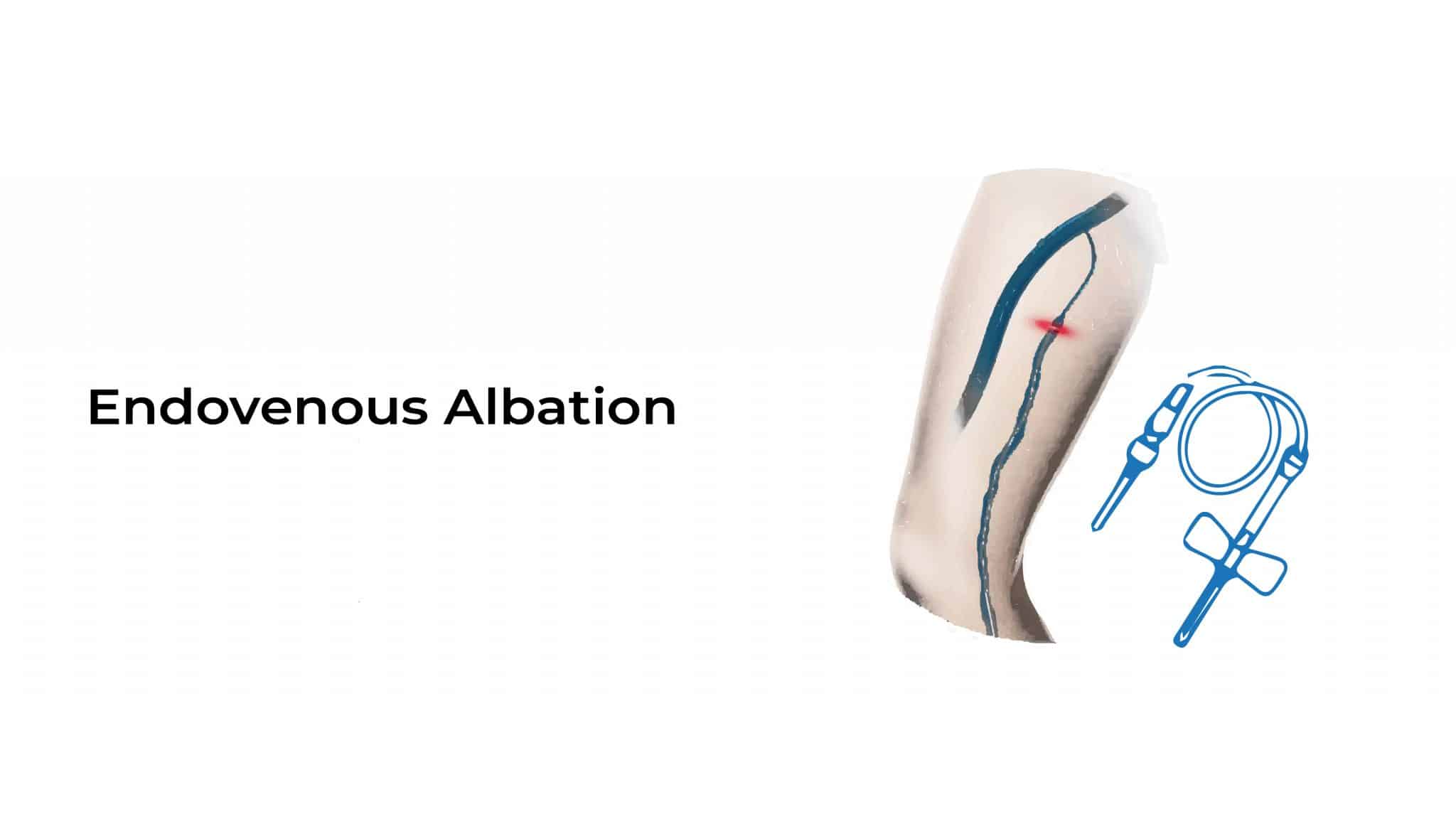 Endovenous Ablation Stat Cardiologist