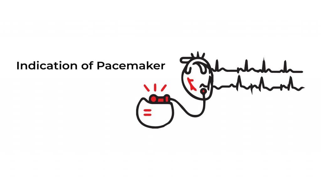 Pacemaker, Defibrillator and Loop Recorders Statcardiologist