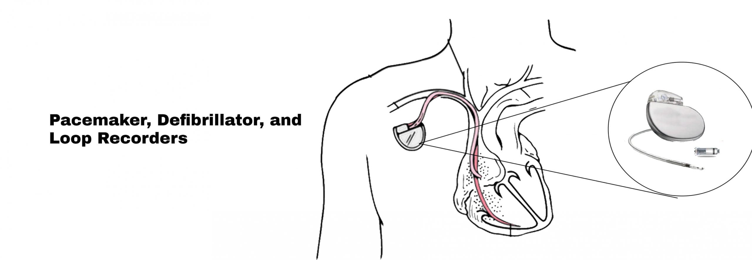 permanent-pacemaker-implantation-stat-cardiologist