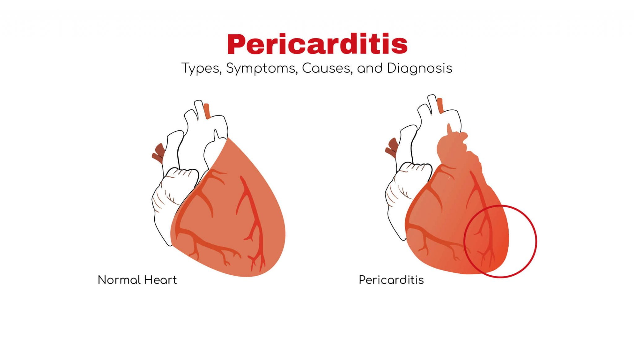 Pericarditis: Types, Symptoms And Diagnosis ~ Stat Cardiologist