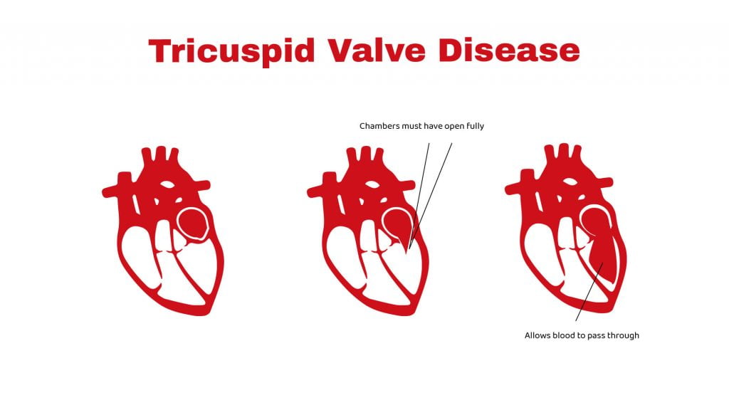 Tricuspid Valve Disease Symptoms Causeandmore ~ Statcardiologist