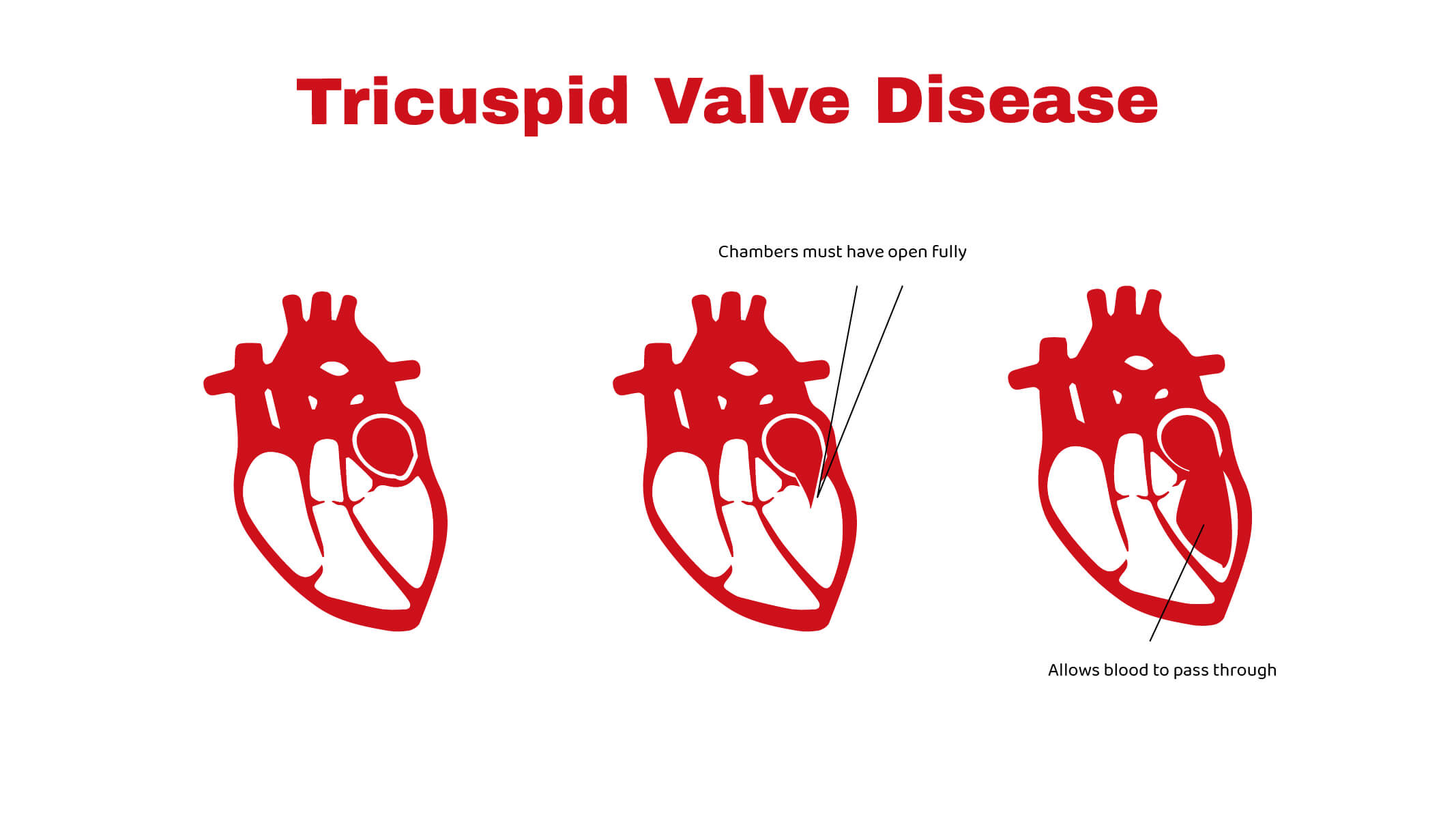Tricuspid Valve Disease Stat Cardiologist