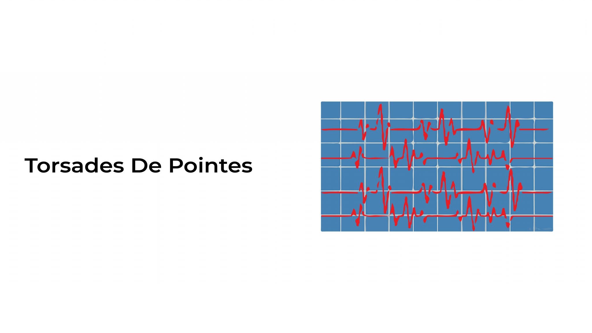 Torsades De Pointes Stat Cardiologist