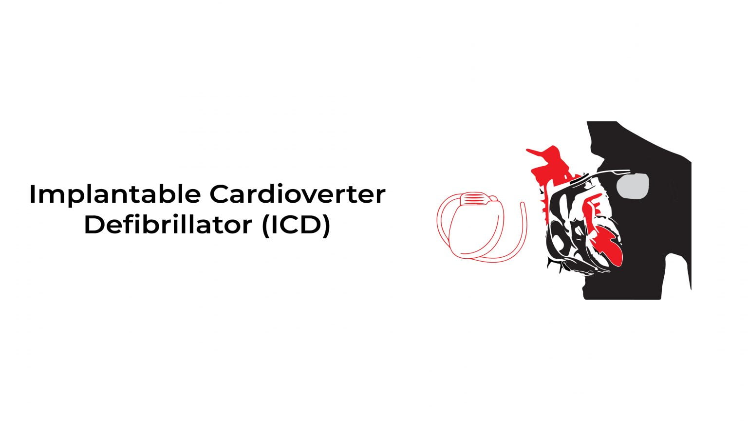 Implantable Cardioverter Defibrillator Icd ~ Stat Cardiologist 