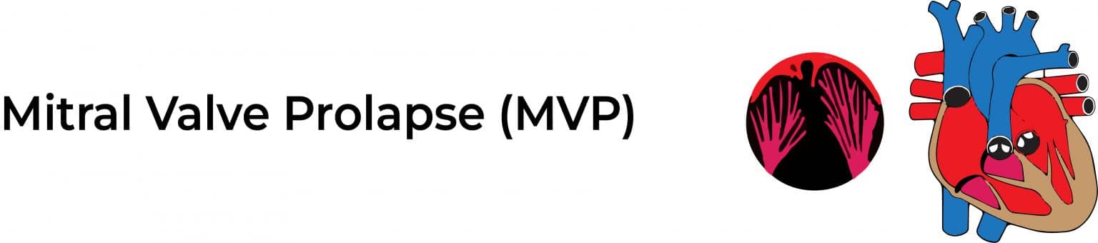 Mitral Valve Prolapse Mvp ~ Stat Cardiologist