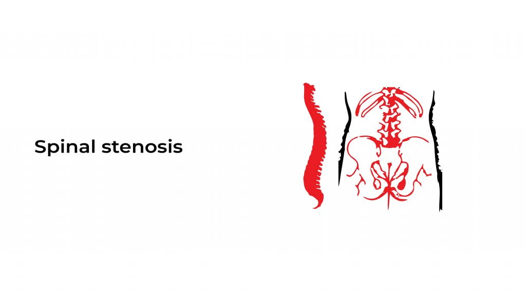 Spinal stenosis Archives Heart Doctor Cardiologist and Internal