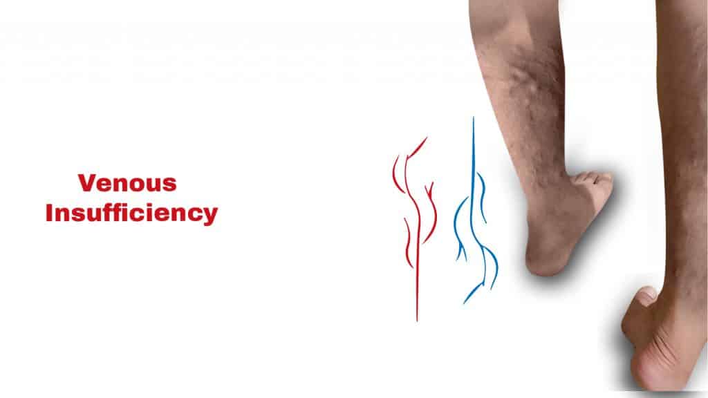 Venous Insufficiency Stat Cardiologist
