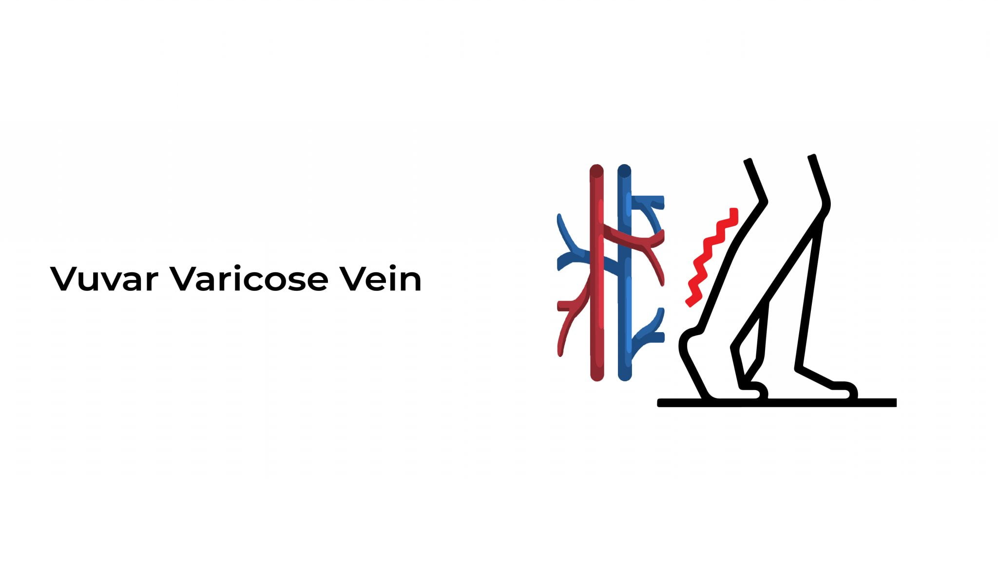 Vulvar Varicose Vein Stat Cardiologist