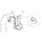 pacemaker-implantation-150x150