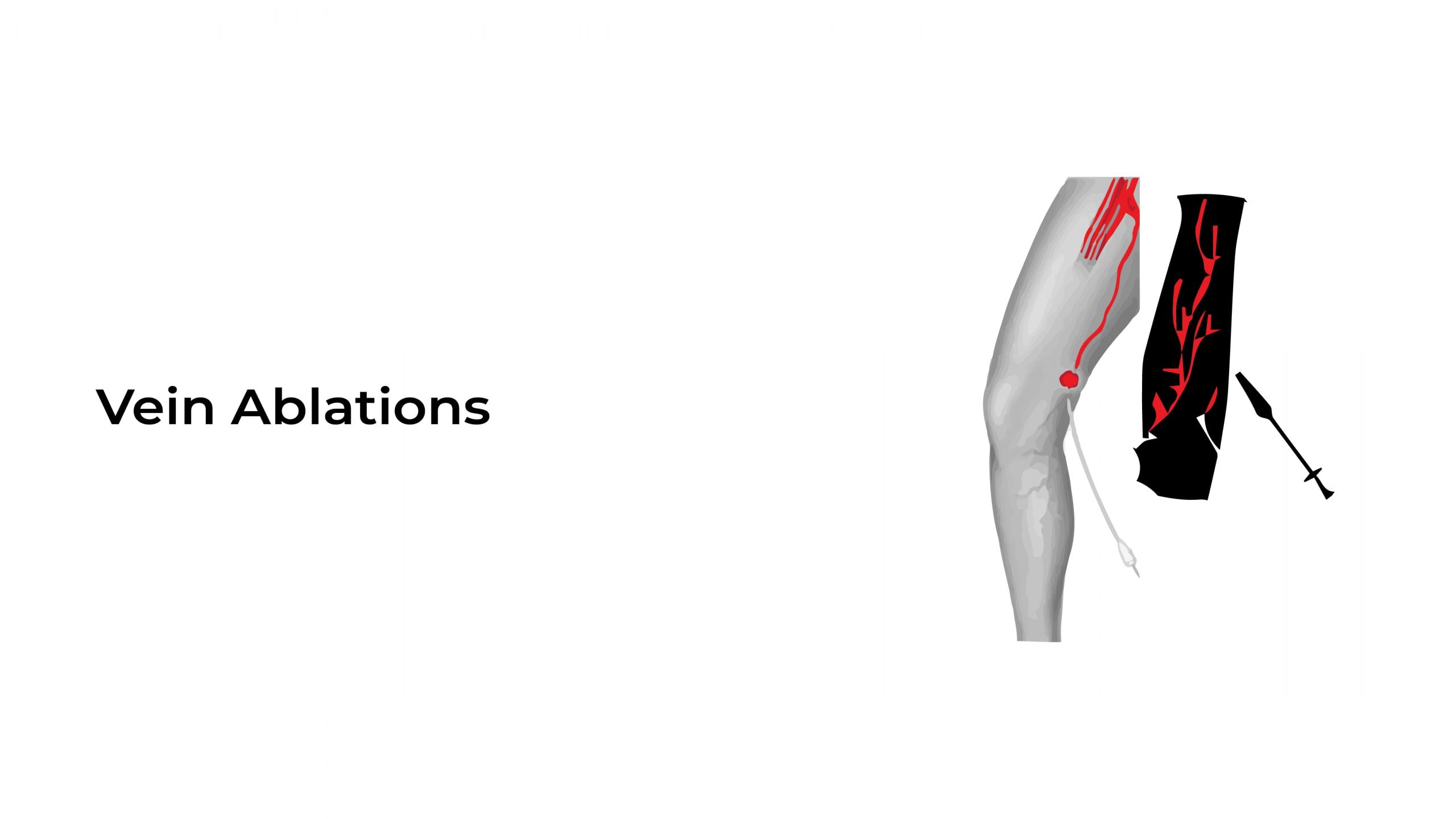 Vein Ablations Stat Cardiologist